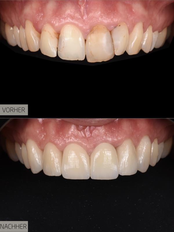 Nachher: Vollständiges Lächeln nach dem Zahnersatz.