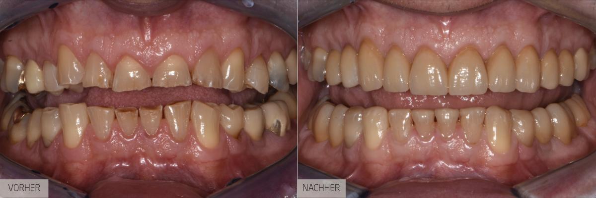 Vorher-Nachher Veneers – Perfekte Zahnoberflächen