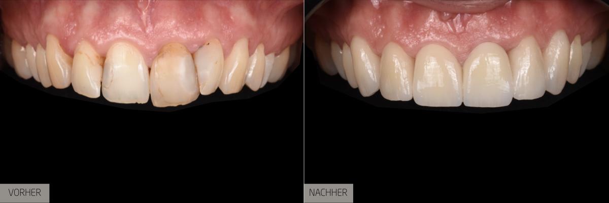 Zahnersatz – Wiederherstellung von Zahnfunktion und Ästhetik