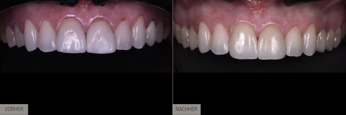 Veneers – Ästhetische Verwandlung der Zähne