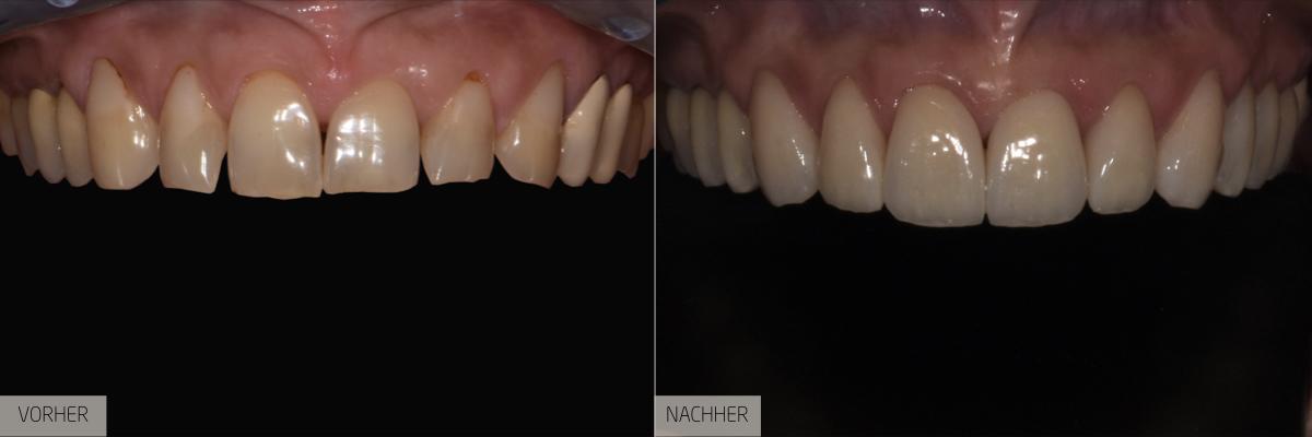 Nachher Zahnbehandlung – Perfektes Lächeln